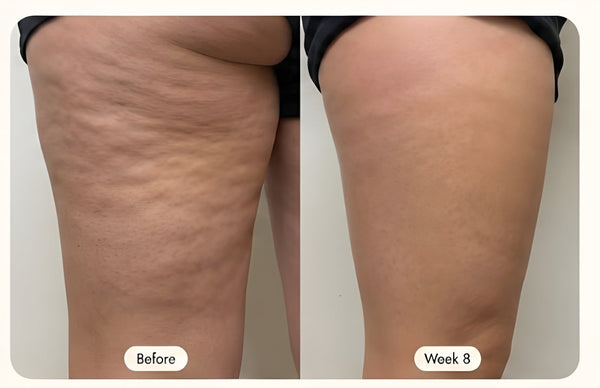 Cellulite Reduction (Thigh)